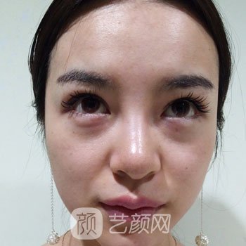 胡琼华博士做去眼袋怎么样？人气骨干医生介绍+去眼袋实例图片