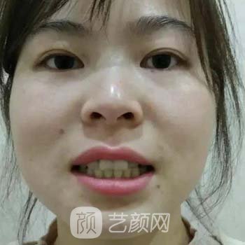 龙岩中医院矫正牙齿怎么样？多少钱？矫正牙齿实例