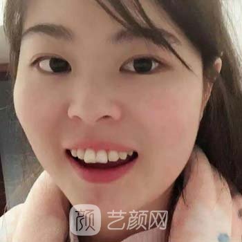 龙岩中医院矫正牙齿怎么样？多少钱？矫正牙齿实例