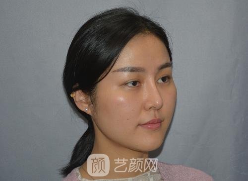 成都素美杨迪双眼皮案例更新｜2023全新体验效果图出炉