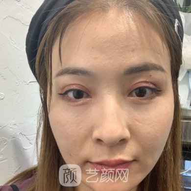 大连艺星医疗美容医院好不好?全新除皱抗衰实例分享