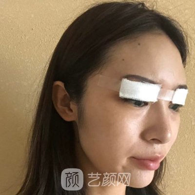 北京王府井医院整形科正规吗?2023双眼皮整形实例分享