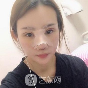 苏州美莱张亮隆鼻案例，鼻子自然美观，手感与真实鼻子没差别