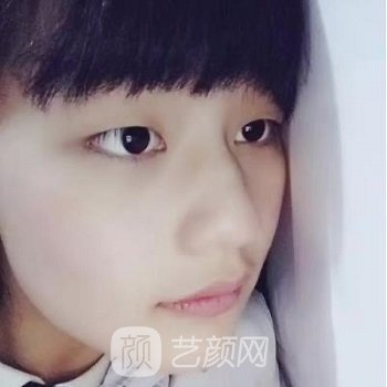 安贞医院李斌斌双眼皮怎么样？价格多少？医生简介+案例图片