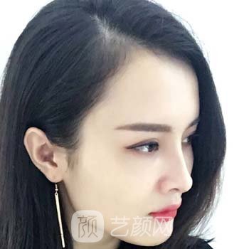 温州张浩医生隆鼻实例，同事都夸我变好看了，内心开心和满足