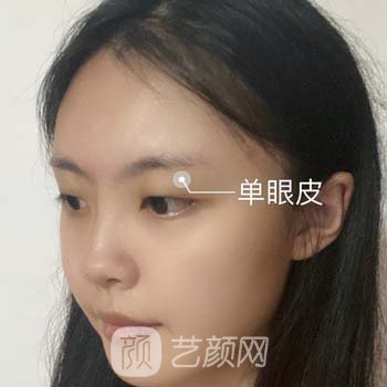 贺光照双眼皮实例，术后精致美丽，成为医生行走的广告牌