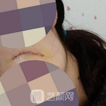 武晓莉修复费用是多少？医生详细介绍+实例对比图