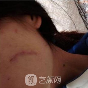 武晓莉修复费用是多少？医生详细介绍+实例对比图