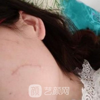 武晓莉修复费用是多少？医生详细介绍+实例对比图