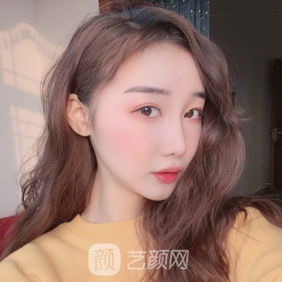南京碧莲盛植发怎么样?全新发际线种植实例曝光