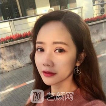李静林双眼皮实例，双眼皮更加自然了，美丽加分