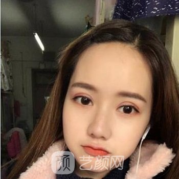 李静林双眼皮实例，双眼皮更加自然了，美丽加分