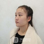 洛阳东方医院双眼皮实例，眼睛漂亮不少，这种感觉真好