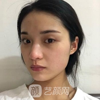 杭州维多利亚美容医院怎么样？正规吗？双眼皮案例+价格表