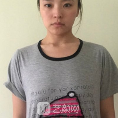 西南医院整形科隆胸实例公开｜附体验对比图