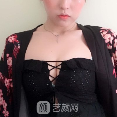 西南医院整形科隆胸实例公开｜附体验对比图