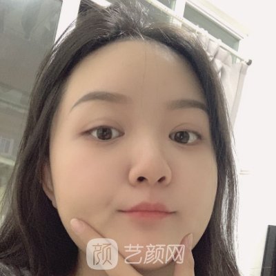 长沙湘雅附二医院整形外科怎么样？全新双眼皮实例一览