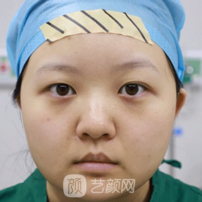 长沙湘雅附二医院整形外科怎么样？全新双眼皮实例一览