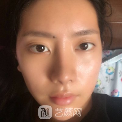 北京贵美汇美容医院隆鼻实例分享｜2023全新体验实例出炉