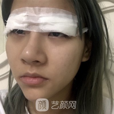 东北国际医院整形科怎么样？全新双眼皮实例分享