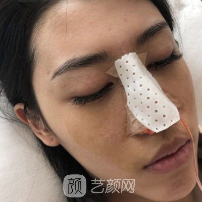 新疆整形美容医院隆鼻实例曝光丨2023招牌实例公开