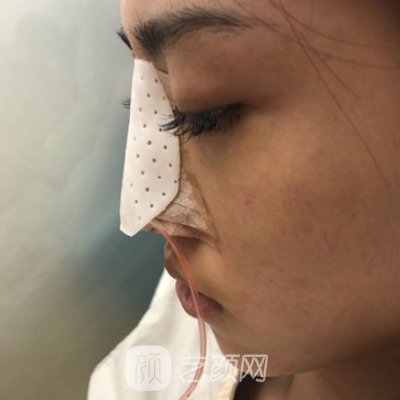 新疆整形美容医院隆鼻实例曝光丨2023招牌实例公开