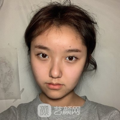 大连沙医生整形医院双眼皮实例分享丨成果自然美观