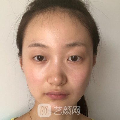 济南莱美双眼皮案例案例展示｜附体验效果图