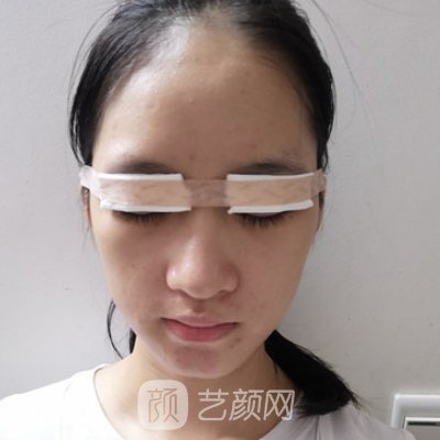 长沙安吉娜整形医院双眼皮整形实例展示丨90天修复细节图