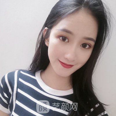 长沙安吉娜整形医院双眼皮整形实例展示丨90天修复细节图