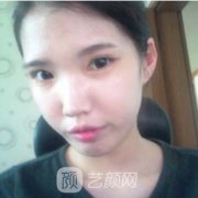 石家庄毛俊涛隆鼻实例,从侧面看特别挺拔,形态比较精致