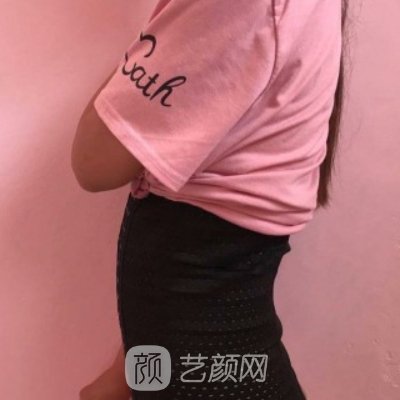 沈阳百嘉丽整形医院腰腹吸脂实例曝光｜成果自然美观