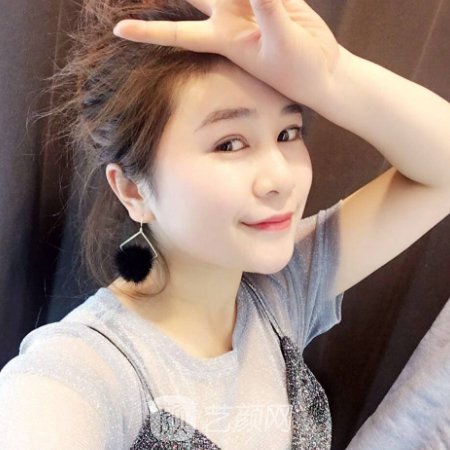 成都东篱医院苟磊医生双眼皮修复怎么样?全新体验实例公开