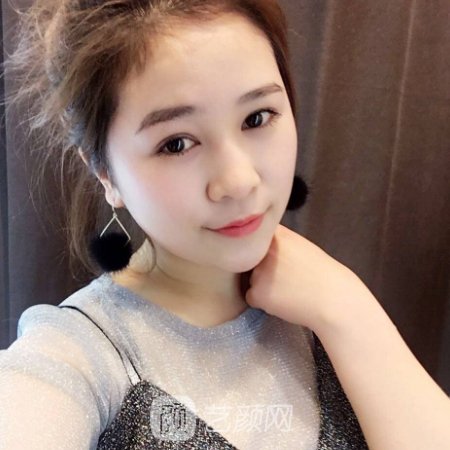 成都东篱医院苟磊医生双眼皮修复怎么样?全新体验实例公开
