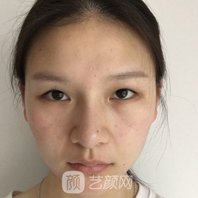 北京正美郑永生割双眼皮怎么样?亲身体验实例曝光