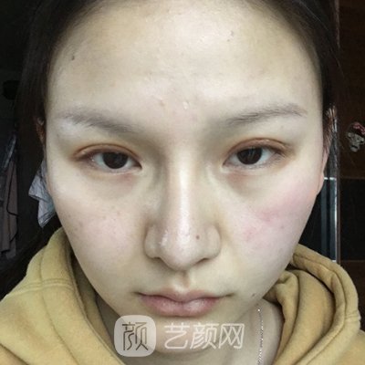 北京正美郑永生割双眼皮怎么样?亲身体验实例曝光