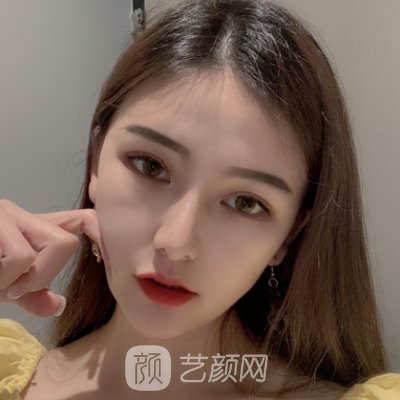北京正美郑永生割双眼皮怎么样?亲身体验实例曝光