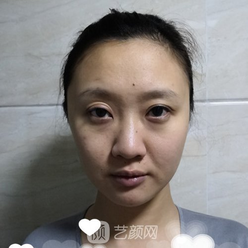 郑州芳艺医疗美容医院怎么样?2023热拉提实例公布