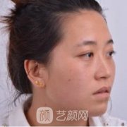 胡华新隆鼻失败修复实例，没有留下疤痕，线条感明显