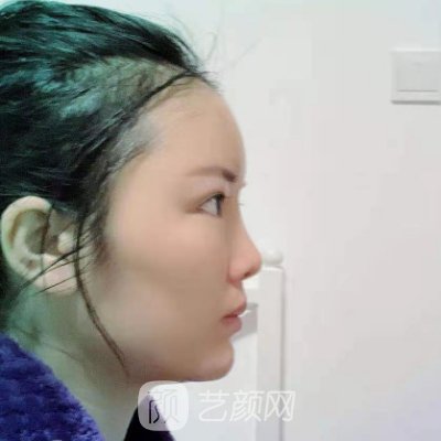 西部战区总医院整形科除皱技术好吗? 医院招牌实例公布