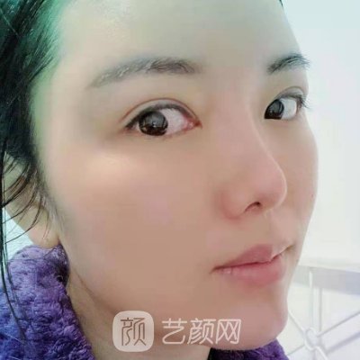 西部战区总医院整形科除皱技术好吗? 医院招牌实例公布