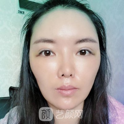 西部战区总医院整形科除皱技术好吗? 医院招牌实例公布