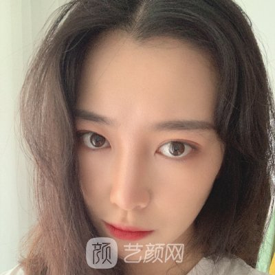 武汉吴昌海割双眼皮怎么样?2023医生招牌实例一览