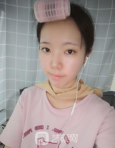 黄敬夏磨骨手术失败修复实例，面部线条柔和，轮廓特别清晰