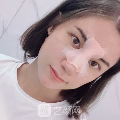 上海悦薇堂整形医院隆鼻实例上线|这是你想要的成果吗?