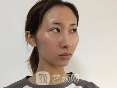 柳大烈教授手术怎么样？医生详细简介+颧骨内推实例