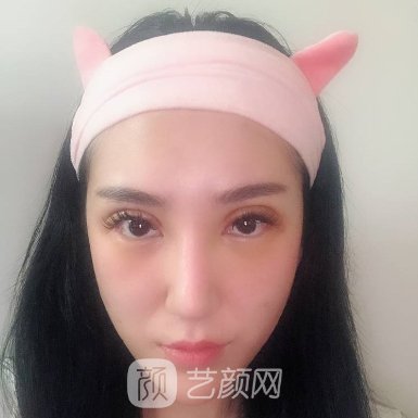 怀化艾美莉整形医院口碑好吗?崭新双眼皮实例公布