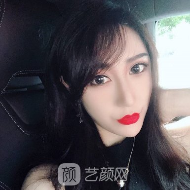 怀化艾美莉整形医院口碑好吗?崭新双眼皮实例公布
