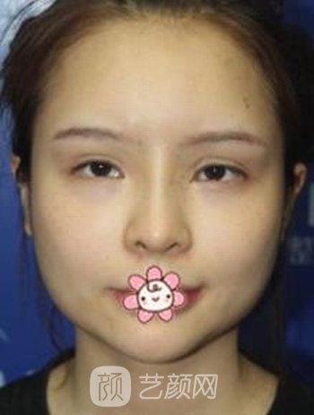 邱立东颧骨内推正规吗？医生简介+颧骨内推实例
