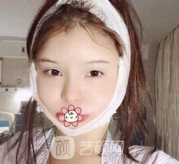 邱立东颧骨内推正规吗？医生简介+颧骨内推实例